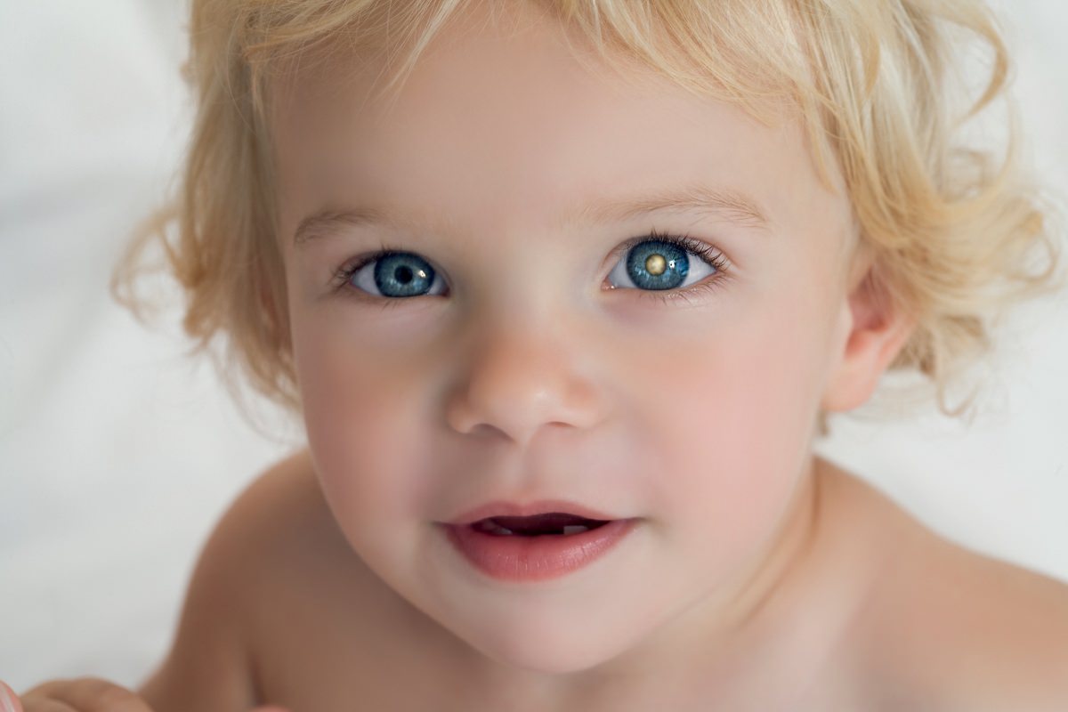 Weiße Pupille auf Blitzlichtfotos ist Warnzeichen von Augenkrebs bei Kindern