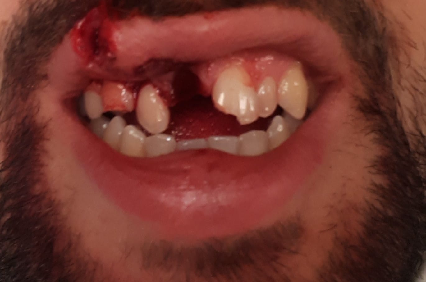 Durch den Sturz hat sich das Opfer einige Zähne ausgeschlagen.